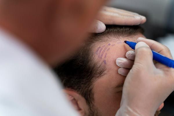 preparazione adulta per estrazione unità follicolari - cliniche private e ospedali per il trapianto capillare