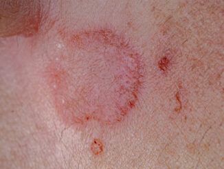 Cancro della pelle e perdita di Capelli