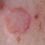 Cancro della pelle e perdita di Capelli