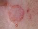 Cancro della pelle e perdita di Capelli