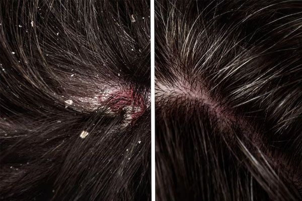 donna con forfora nei capelli e cuoio capelluto squamoso - migliori cliniche trapianto capelli Italia