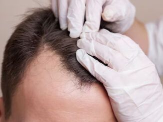 esperienze dirette con medici esperti in trapianto capelli