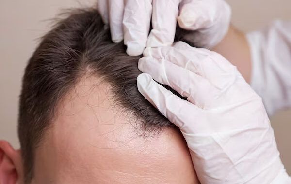 esperienze dirette con medici esperti in trapianto capelli