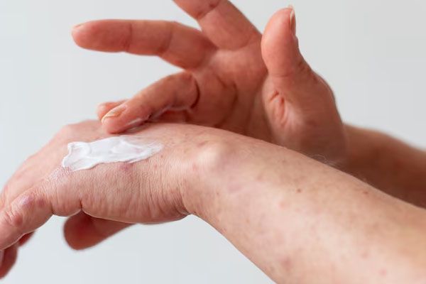 mani che applicano la crema per la pelle - Trattamenti naturali dermatite seborroica