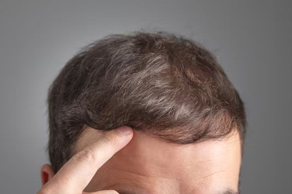 primo piano dei capelli di un uomo indicati dal suo stesso dito - trapianto capelli Italia 