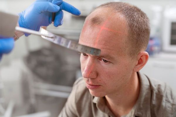 problemi adulti calvizie - trapianto capelli Italia 