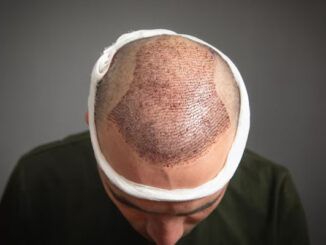 trapianto capillare protocolli