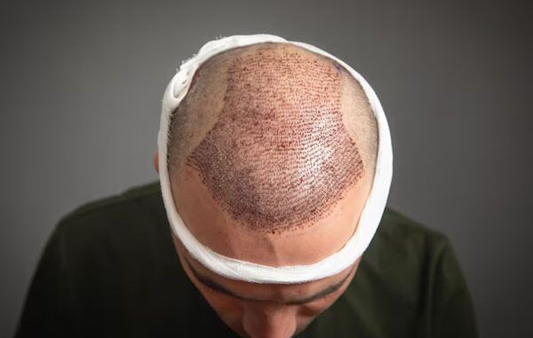 trapianto capillare protocolli