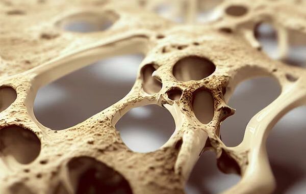 Cos'è l'osteoporosi