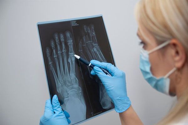 Medico o radiologo che tiene una radiografia della lesione al ginocchio e alla gamba di una persona, dia - diagnosi osteogenesi imperfetta