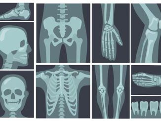 Osteogenesi imperfetta