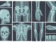 Osteogenesi imperfetta
