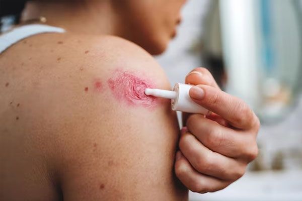 donna che applica un trattamento per la pelle sulla spalla