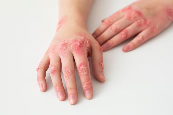 mani di un paziente affetto da malattie della pelle