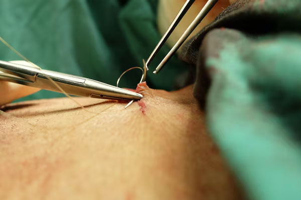 primo piano dei medici che eseguono una sutura