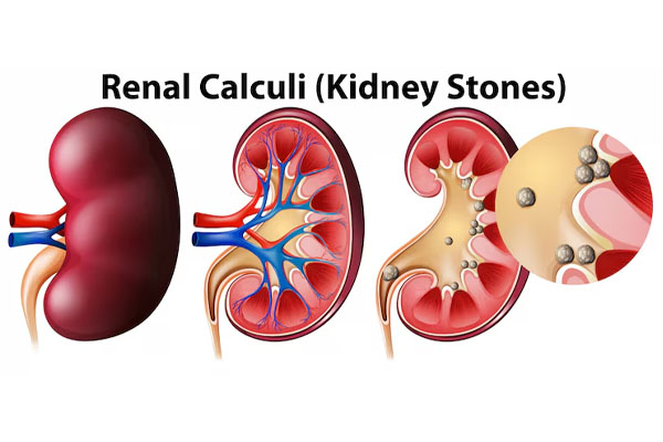 Illustrazione di un diagramma di calcoli renali