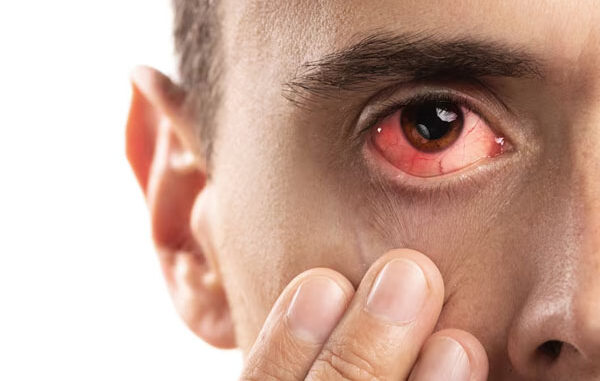 Occhio rosso_ cause più comuni e quando rivolgersi al medico