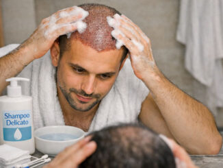 Trattamento medico dopo un trapianto di capelli