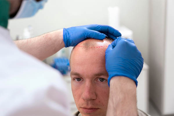 trattamento per uomo calvo