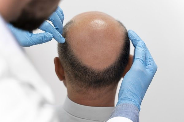 Un medico dermatologo esegue l'esame iniziale del cuoio capelluto di un paziente in uno studio medico tricologico