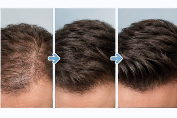 Capelli trapiantati che restano nel tempo
