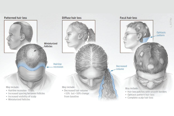 Distinzione tra diversi tipi di alopecia