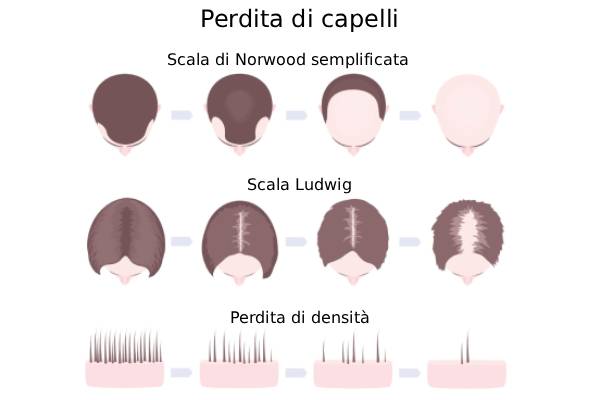 Schema illustrativo della distribuzione del diradamento e della zona donatrice nel cuoio capelluto femminile