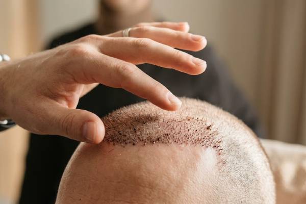 Primo piano di una mano sospesa sopra un cuoio capelluto appena trapiantato, che illustra l'importanza di non toccare gli innesti