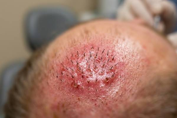 Macrofotografia di un'area del cuoio capelluto con innesti che mostra un intenso arrossamento e un gonfiore anomalo che richiede una valutazione medica
