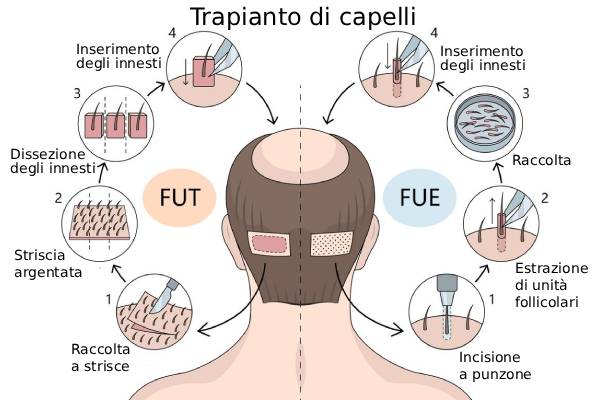 Schema illustrativo delle differenze tra prelievo FUE e prelievo a striscia FUT