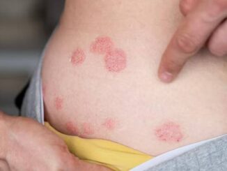 Epidermolisi bollosa