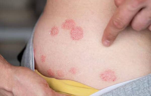 Epidermolisi bollosa