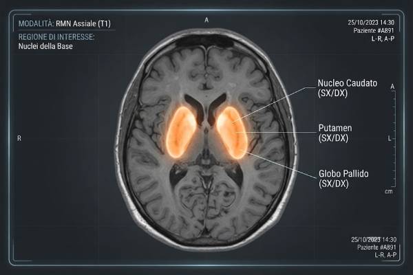 Visualizzazione concettuale di una risonanza magnetica cerebrale con evidenziazione dei nuclei della base