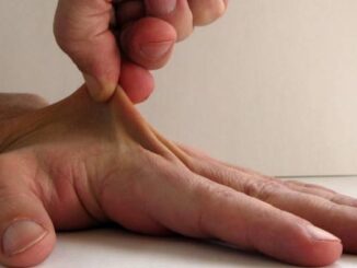 Sindrome di Ehlers-Danlos vascolare
