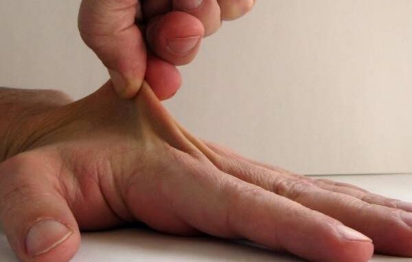 Sindrome di Ehlers-Danlos vascolare