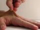 Sindrome di Ehlers-Danlos vascolare