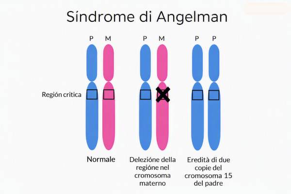 Diagramma schematizzato del cromosoma 15 con indicazione delle alterazioni genetiche