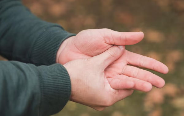 Sindrome della mano estranea