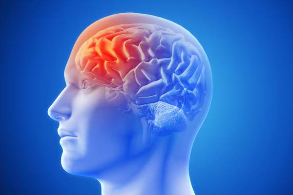 Schema grafico del cervello umano evidenziando con bagliori caldi le aree visive e parietali durante un attacco emicranico